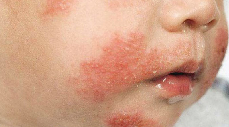 Mẹ đọc nhãn thực phẩm cẩn thận cho bé dị ứng đạm sữa bò